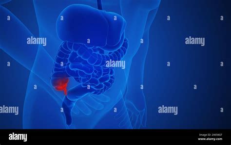 Image result for Appendix Pain Area