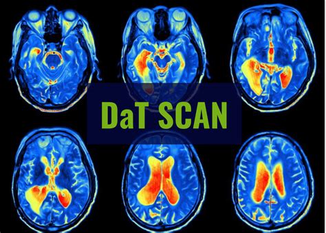 Rezultat imagine pentru Dat Brain Scan