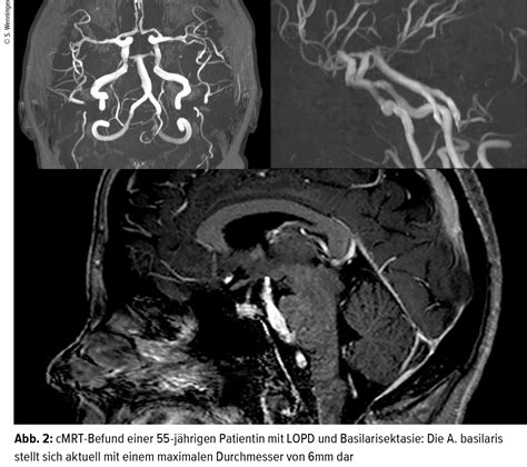 Diagnostik und Therapie des Late-onset-Morbus-Pompe - Neurologie ...