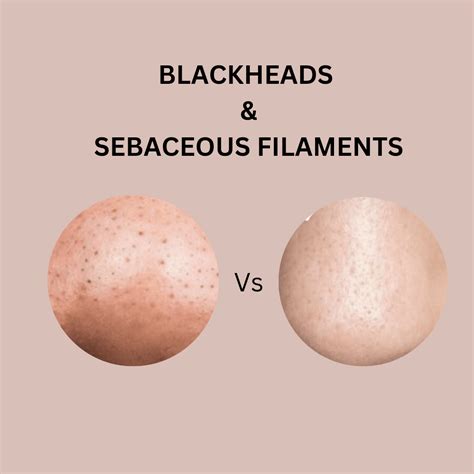 How to Get Rid of Blackheads and Sebaceous Filaments Naturally: A Guid - Caithy Organics