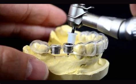 Cotisen Dental Implant Guide System Kit : Amazon.in: Industrial ...