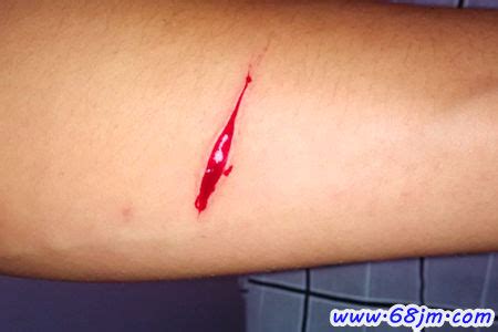 菜刀切伤手指破伤风手被菜刀切伤怎么处理2022已更新今日更新