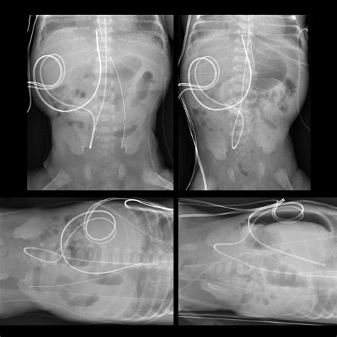 nasogastric tube | pacs