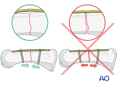 Compression Plate Fixation 的图像结果