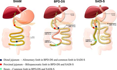 Image result for Colon Polyps Types