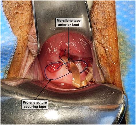 Vaginal Erosion of a Prior Transabdominal Cerclage - Journal of Minimally Invasive Gynecology
