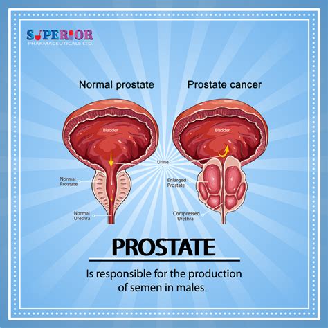 Enlarged Prostate Cancer