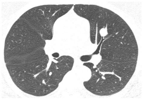 Primary Pulmonary Myxoid Sarcoma in an Asymptomatic 47-Year-Old Female