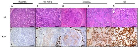 Human Liver Regeneration: An Etiology Dependent Process