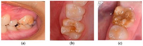 Potential Association of Molar-Incisor Hypomineralization (MIH) with ...