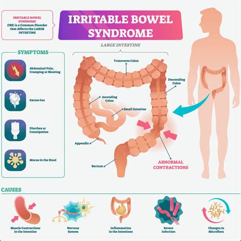 Irritable Bowel Disease Causes, Risk Factors, Symptoms, Treatment