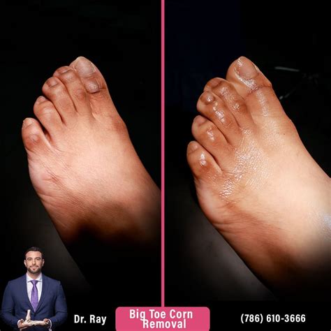 Corn Removal Surgery Before and After Photos - Luxe Foot Surgery