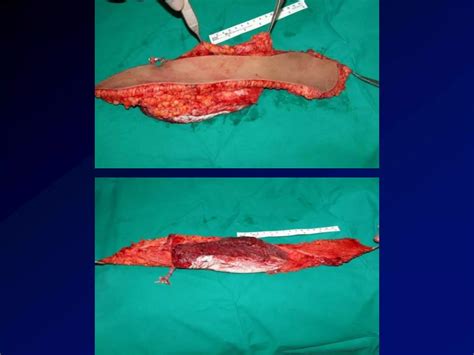 Versatility of anterolateral thigh free flap n. rajacic md | PDF