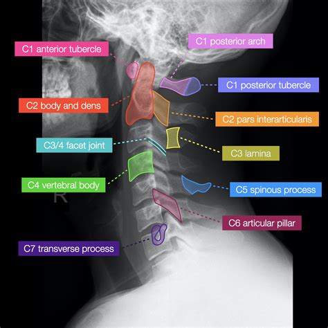 What Is Cervical Burnout Radiograph at Victoria Thomason blog - neck x ray