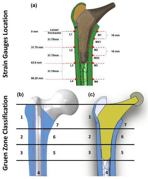 Stress Shielding and Bone Resorption of Press-Fit Polyether–Ether–Ketone (PEEK) Hip Prosthesis ...