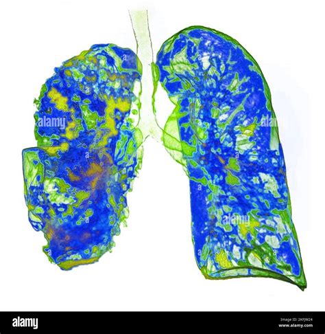 Pneumonia, 3D CT scan Stock Photo - Alamy