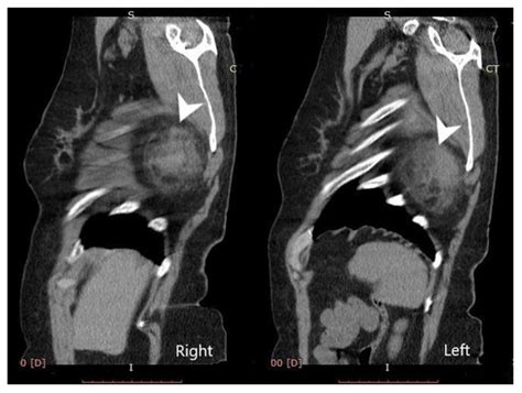 Elastofibroma Dorsi, a Rare Condition, with Challenging Diagnosis. Case ...