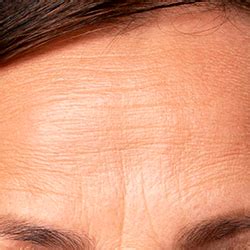 MNRF – Microneedling RF Tightening | Wizderm