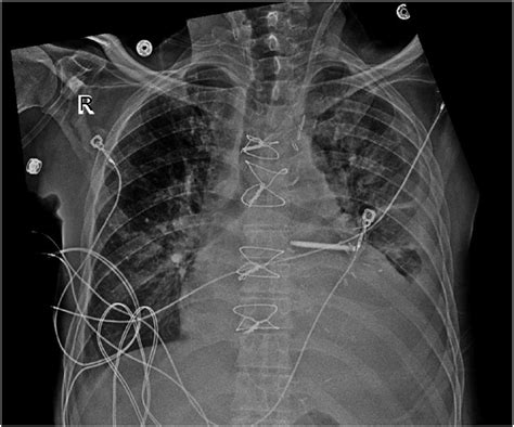Inadvertent Suturing of a Left Internal Jugular Vein Catheter Into the ...