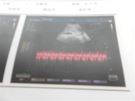 【怀孕十一周胎儿高清图】【图】怀孕十一周胎儿高清图片赏析 分享在此阶段的注意事项(2)_伊秀亲子|yxlady.com