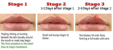 what are signs of herpes