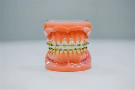 Night Guards To Protect Gums And Teeth