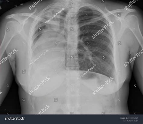 Abnormal Chest X Ray