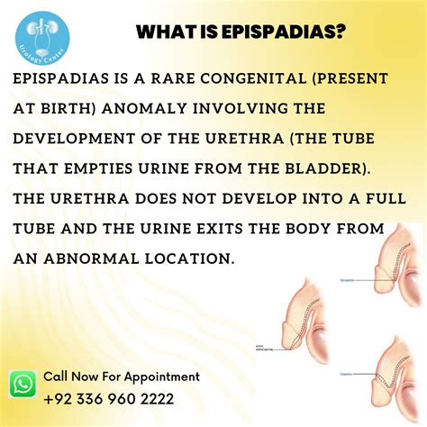Epispadias Vs Hypospadias