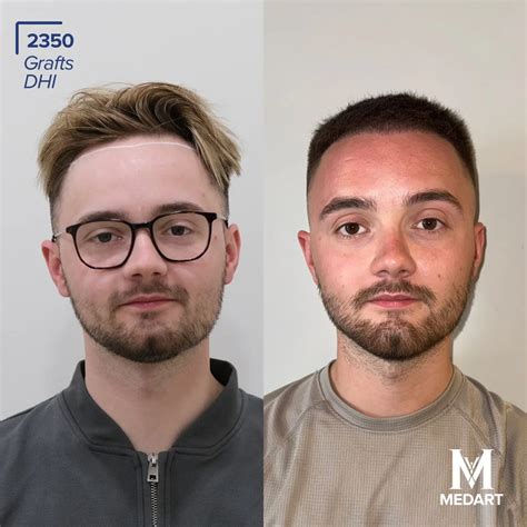 Turkey Hair Transplant Package