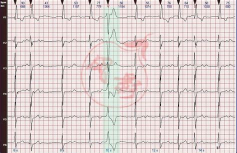 心电图病例分析：心房颤动伴完全性左束支阻滞 - 爱爱医医学网