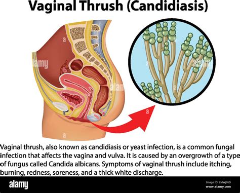 Vaginal Thrush (Candidiasis) infographic with explanation illustration ...