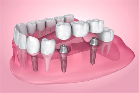 Dental Bridge Options & Costs