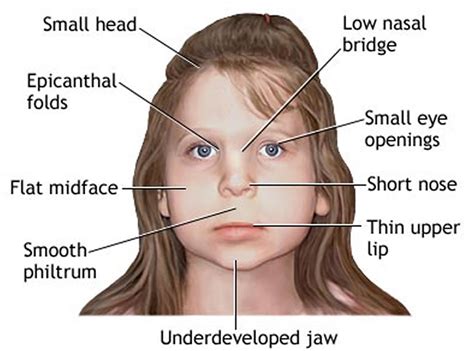 Fetal Alcohol Syndrome - Signs & Symptoms, In Baby, Adults & Treatment