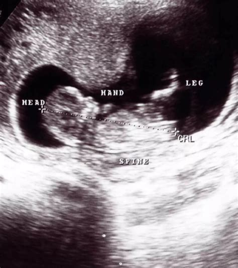 High WBC Count In Pregnancy: Causes, Risks & Expert Insights