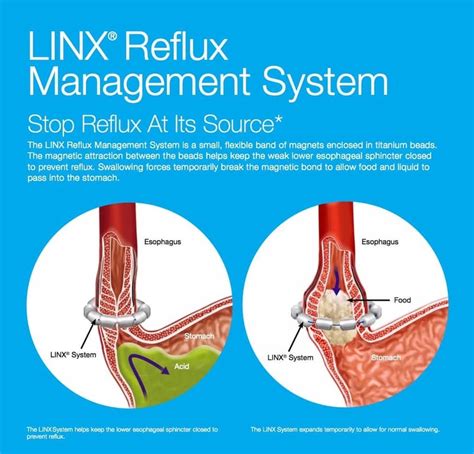 Image result for Linx Procedure Recovery