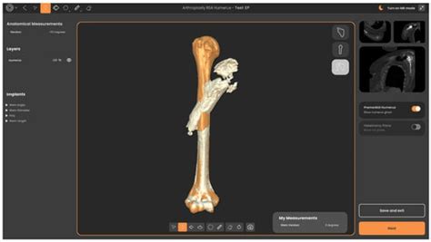Allograft Prosthetic Composite (APC) for Proximal Humeral Bone ...