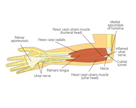 Ulnar Nerve Entrapment | Upswing Health