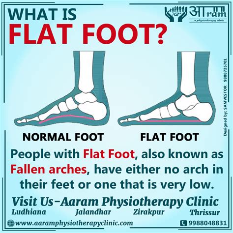 How Does Flat Feet Happen at Darren Pennington blog