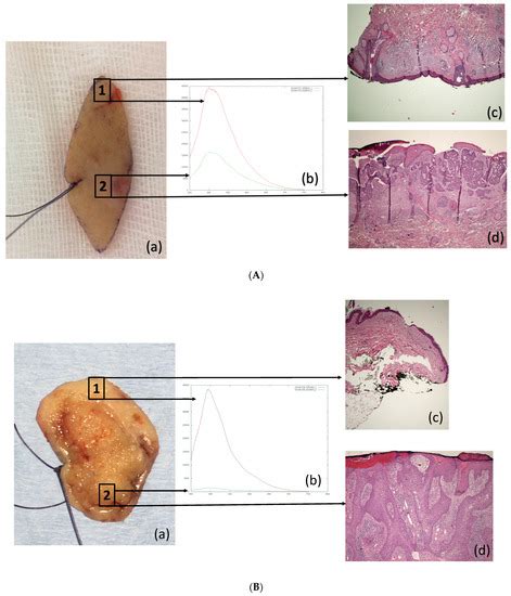 Correlation between Autofluorescence Intensity and Histopathological ...
