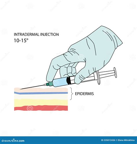 Intradermal Injection. Effective Methods of Administration of Drugs and Other Medical Solutions ...