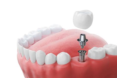 Tooth Implants Procedure 的图像结果