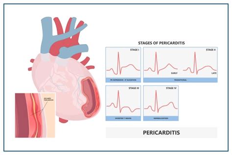 Pericarditis: Symptoms, Causes, Diagnosis, Prevention
