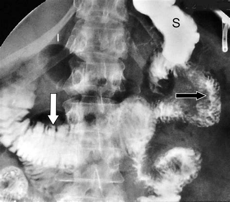 Small-Bowel Complications of Major Gastrointestinal Tract Surgery | AJR