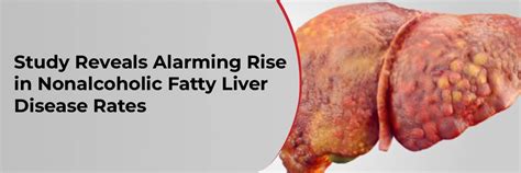 Study Reveals Alarming Rise in Nonalcoholic Fatty Liver Disease Rates