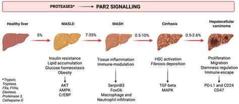 The Role of PAR2 in MASLD Progression and HCC Development