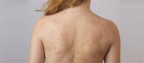 Zinc PCA for acne-prone skin? All you need to know – Re'equil