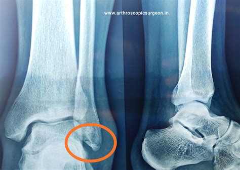 Ankle sprain – Best Orthopedic doctor in Jaipur