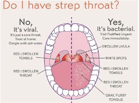 Sore throat