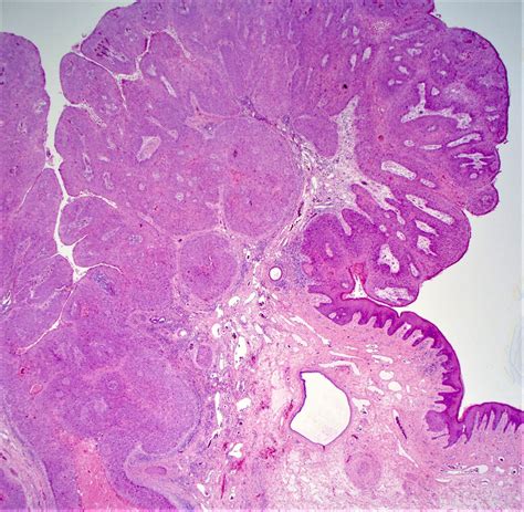 Thrombosed Hemorrhoid Histology