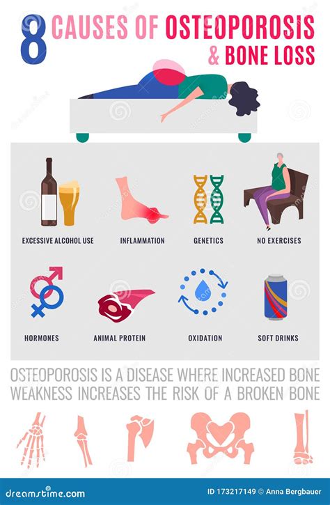 Causes of Osteoporosis and Bone Loss Stock Illustration - Illustration of healthy, information ...
